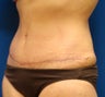 Tummy Tuck
