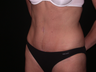 Tummy Tuck (Abdominoplasty)