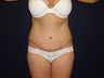 Tummy Tuck