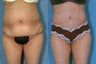 Tummy Tuck