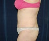 Tummy Tuck