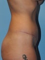 Tummy Tuck