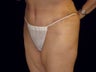 Tummy Tuck