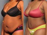 Tummy Tuck