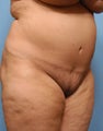 Tummy Tuck