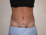 Tummy Tuck