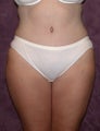 Tummy Tuck