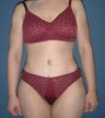 Tummy Tuck