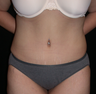 Tummy Tuck