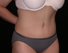 Tummy Tuck