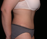 Tummy Tuck