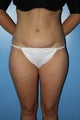 Abdominoplasty