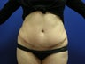 Tummy Tuck