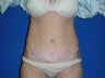 Tummy Tuck