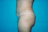 Tummy Tuck