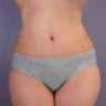 Tummy Tuck
