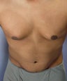 Male Body Contouring