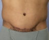 Male Body Contouring