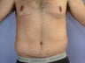 After Weight Loss