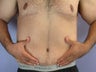 After Weight Loss