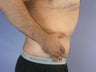 After Weight Loss Male Tummy Tuck