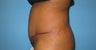 tummy tuck