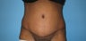 tummy tuck