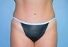 Tummy Tuck with Liposuction