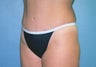 Tummy Tuck with Liposuction