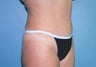 Tummy Tuck with Liposuction
