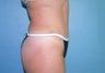 Tummy Tuck with Liposuction
