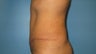 tummy tuck