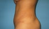 tummy tuck