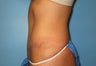 tummy tuck