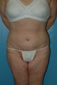 Abdominoplasty (tummy tuck)