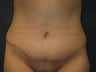 Tummy Tuck