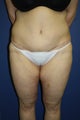 Abdominoplasty (tummy tuck)