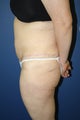 Abdominoplasty (tummy tuck)