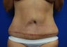 Tummy Tuck