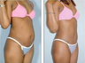 Tummy Tuck
