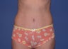Before & After Abdominoplasty