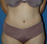 Tummy Tuck