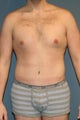 Male tummy tuck