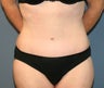 Tummy Tuck