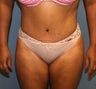 tummy tuck