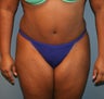 Tummy tuck