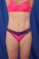 Tummy Tuck