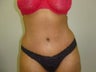 Tummy Tuck