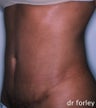 Tummy Tuck