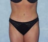 Tummy Tuck